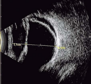 Ultrassonografia com descolamento da retina