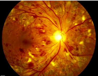 Hemorragia e gordura na retinopatia diabética