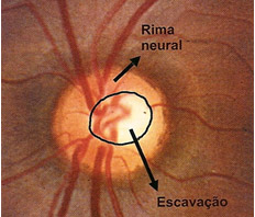 Figura 1 - Nervo óptico normal